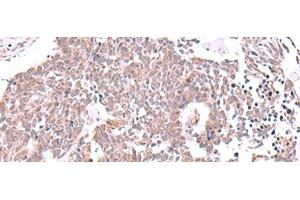 Immunohistochemistry of paraffin-embedded Human lung cancer tissue using JDP2 Polyclonal Antibody at dilution of 1:40(x200) (JDP2 anticorps)