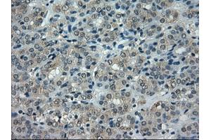 Immunohistochemical staining of paraffin-embedded Carcinoma of thyroid tissue using anti-CRYABmouse monoclonal antibody. (CRYAB anticorps)