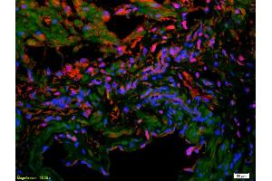 Formalin-fixed and paraffin-embedded human colon carcinoma labeled with Anti-VE Cadherin/VECD/CD144 Polyclonal Antibody, Unconjugated (ABIN1387250) 1:200, overnight at 4°C, The secondary antibody was Goat Anti-Rabbit IgG, Cy3 conjugated used at 1:200 dilution for 40 minutes at 37°C.