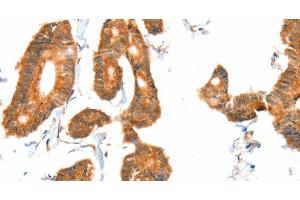 Immunohistochemistry of paraffin-embedded Human colon cancer tissue using ACOX1 Polyclonal Antibody at dilution 1:40 (ACOX1 anticorps)