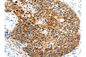 The image on the left is immunohistochemistry of paraffin-embedded Human esophagus cancer tissue using ABIN7191028(HUNK Antibody) at dilution 1/35, on the right is treated with synthetic peptide. (HUNK anticorps)