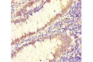 Immunohistochemistry of paraffin-embedded human colon cancer using ABIN7150029 at dilution of 1:100 (DAAM2 anticorps  (AA 1-101))