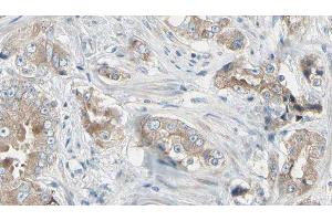 ABIN6278748 at 1/100 staining Human prostate tissue by IHC-P. (LRRK1 anticorps  (C-Term))
