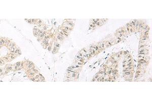 Immunohistochemistry of paraffin-embedded Human liver cancer tissue using HABP4 Polyclonal Antibody at dilution of 1:60(x200) (HABP4 anticorps)