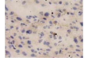 Immunohistochemical staining of human liver cancer tissue section with IL18 monoclonal antibody, clone 2  at 1:10 dilution. (IL-18 anticorps)