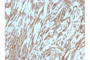 Formalin-fixed, paraffin-embedded human Leiomyosarcoma stained with Muscle Specific Actin Mouse Monoclonal Antibody (MSA/953). (ACTA1/ACTA2A/ACTG2 anticorps)