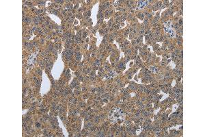 Immunohistochemistry of Human lung cancer using PDIA2 Polyclonal Antibody at dilution of 1:50 (PDIA2 anticorps)