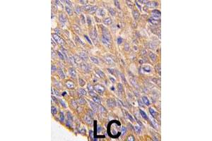 Formalin-fixed and paraffin-embedded human lung carcinoma tissue reacted with TOB2 polyclonal antibody  , which was peroxidase-conjugated to the secondary antibody, followed by DAB staining. (TOB2 anticorps  (N-Term))