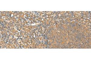 Immunohistochemistry of paraffin-embedded Human tonsil tissue using HTT Polyclonal Antibody at dilution of 1:25(x200) (Huntingtin anticorps)