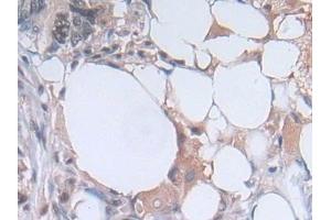 Detection of PGK1 in Human Colorectal cancer Tissue using Polyclonal Antibody to Phosphoglycerate Kinase 1 (PGK1)