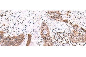 Immunohistochemistry of paraffin-embedded Human esophagus cancer tissue using SCCPDH Polyclonal Antibody at dilution of 1:85(x200)
