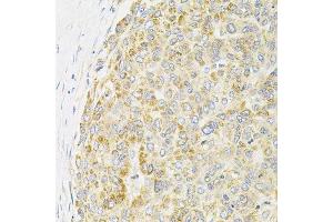 Immunohistochemistry of paraffin-embedded human liver cancer using PPP1CA antibody.