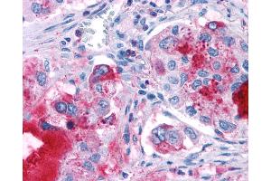 Anti-GPR82 antibody IHC of human Lung, Adenocarcinoma.