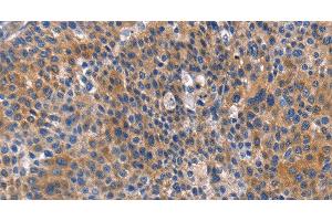 Immunohistochemistry of paraffin-embedded Human liver cancer tissue using ARRB1 Polyclonal Antibody at dilution 1:50
