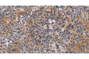 Immunohistochemistry of paraffin-embedded Human liver cancer tissue using ARRB1 Polyclonal Antibody at dilution 1:50 (beta Arrestin 1 anticorps)