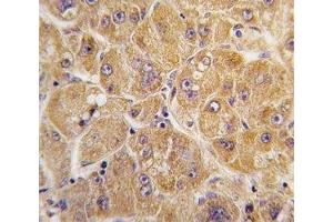 IHC analysis of FFPE human hepatocarcinoma tissue stained with ALDH1A1 antibody