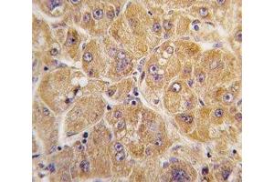 IHC analysis of FFPE human hepatocarcinoma tissue stained with ALDH1A1 antibody (ALDH1A1 anticorps  (AA 302-331))