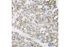 Immunohistochemistry of paraffin-embedded human esophageal cancer using ZAK antibody (ABIN6133445, ABIN6150360, ABIN6150361 and ABIN6223229) at dilution of 1:100 (40x lens).