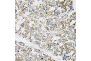 Immunohistochemistry of paraffin-embedded human esophageal cancer using ZAK antibody (ABIN6133445, ABIN6150360, ABIN6150361 and ABIN6223229) at dilution of 1:100 (40x lens). (ZAK anticorps  (AA 1-330))