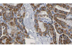 ABIN6267160 at 1/100 staining Human thyroid cancer tissue by IHC-P. (PRAS40 anticorps  (pSer183))