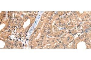 Immunohistochemistry of paraffin-embedded Human thyroid cancer tissue using CA7 Polyclonal Antibody at dilution of 1:50(x200) (CA7 anticorps)