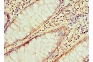 Immunohistochemistry of paraffin-embedded human colon cancer using ABIN7156754 at dilution of 1:100 (IRAK2 anticorps  (AA 1-270))