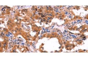 Immunohistochemistry of paraffin-embedded Human thyroid cancer using ERAS Polyclonal Antibody at dilution of 1:40