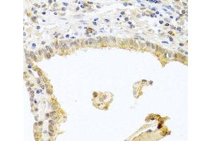 Immunohistochemistry of paraffin-embedded Human lung cancer using PRKCA Polyclonal Antibody at dilution of 1:100 (40x lens).