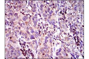 Immunohistochemical analysis of paraffin-embedded endometrial cancer tissues using ABCC4 mouse mAb with DAB staining.