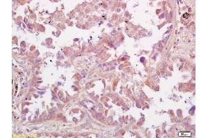 Formalin-fixed and paraffin embedded human lung carcinoma labeled with Rabbit Anti RSV Polyclonal Antibody, Unconjugated (ABIN674109) at 1:200 followed by conjugation to the secondary antibody and DAB staining