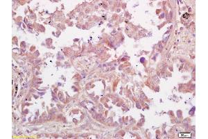 Formalin-fixed and paraffin embedded human lung carcinoma labeled with Rabbit Anti RSV Polyclonal Antibody, Unconjugated (ABIN674109) at 1:200 followed by conjugation to the secondary antibody and DAB staining (RSV anticorps  (AA 151-250))