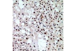 Immunohistochemical analysis of CHD4 staining in human liver cancer formalin fixed paraffin embedded tissue section. (CHD4 anticorps)