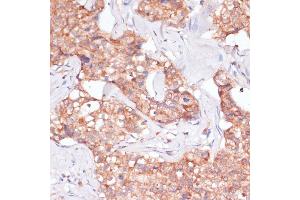 Immunohistochemistry of paraffin-embedded human breast cancer using TIMM8B antibody (ABIN7270928) at dilution of 1:100 (40x lens).