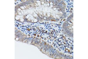Immunohistochemistry of paraffin-embedded human colon carcinoma using STING antibody (ABIN7270958) at dilution of 1:25 (40x lens). (STING/TMEM173 anticorps)
