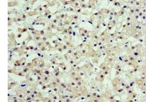 Immunohistochemistry of paraffin-embedded human liver cancer using ABIN7143462 at dilution of 1:100 (ARFGAP3 anticorps  (AA 217-516))