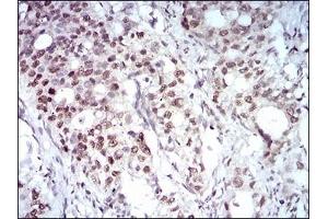 Immunohistochemical analysis of paraffin-embedded human cervical cancer tissues using MAPK7 mouse mAb with DAB staining. (MAPK7 anticorps  (AA 411-556))