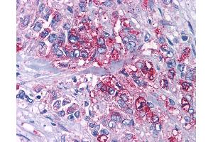 Anti-P2RY4 / P2Y4 antibody IHC of human Pancreas, Carcinoma. (P2RY4 anticorps  (Cytoplasmic Domain))