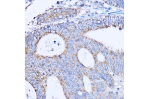 Immunohistochemistry of paraffin-embedded human colon carcinoma using MT-ND3 antibody (ABIN7268601) at dilution of 1:100 (40x lens). (MT-ND3 anticorps)