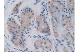 Detection of GHRH in Human Stomach cancer Tissue using Monoclonal Antibody to Growth Hormone Releasing Hormone (GHRH)