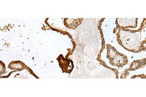 Immunohistochemistry of paraffin-embedded Human thyroid cancer tissue using UBE2Z Polyclonal Antibody at dilution of 1:35(x200) (UBE2Z anticorps)