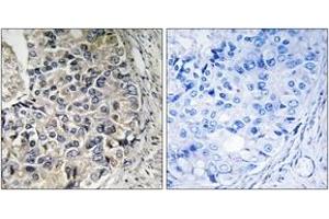 Immunohistochemistry analysis of paraffin-embedded human prostate carcinoma tissue, using CMC1 Antibody. (CMC1 anticorps  (AA 391-440))