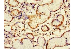 Immunohistochemistry of paraffin-embedded human gastric cancer using ABIN7145670 at dilution of 1:100 (C6orf89 anticorps  (AA 120-320))