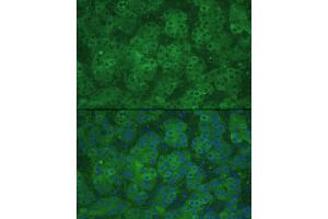 Immunofluorescence analysis of human liver cancer using CBS Rabbit pAb (ABIN3021958, ABIN3021959, ABIN3021960 and ABIN6218521) at dilution of 1:100 (40x lens). (CBS anticorps  (AA 252-551))