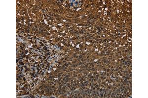 Immunohistochemistry of Human colon cancer using MYBBP1A Polyclonal Antibody at dilution of 1:40