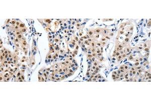 Immunohistochemistry of paraffin-embedded Human lung cancer tissue using MAGEA6 Polyclonal Antibody at dilution 1:120 (MAGEA6 anticorps)