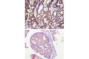 Paraffin embedded sections of human colon cancer tissue were incubated with ACOT11 monoclonal antibody, clone J4B2  (1:100) for 2 hours at room temperature. (ACOT11 anticorps  (AA 19-250))