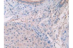 IHC-P analysis of Human Glioma Tissue, with DAB staining. (IL-33 anticorps  (AA 112-270))