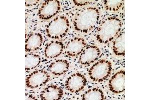 Immunohistochemical analysis of ZNF839 staining in human colon cancer formalin fixed paraffin embedded tissue section. (ZNF839 anticorps)