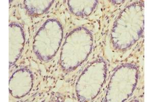Immunohistochemistry of paraffin-embedded human colon cancer using ABIN7153651 at dilution of 1:100