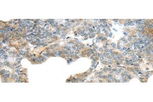Immunohistochemistry of paraffin-embedded Human thyroid cancer using SERPINB11 Polyclonal Antibody at dilution of 1/20 (SERPINB11 anticorps)